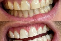 Smile-and-Beauty-Ustron-Wybielanie-zebow-10