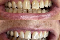 Smile-and-Beauty-Ustron-Wybielanie-zebow-7
